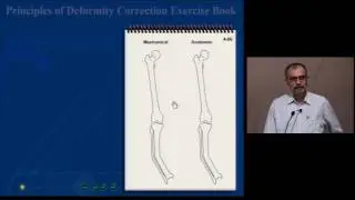 Tibial Uniapical Deformity