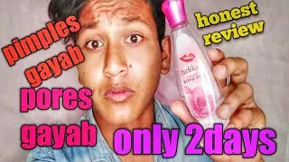 Dabur gulabari rose water honest review/ best pimple removal