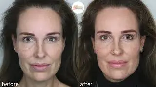 Behandeling met tca #peeling bij #pigmentation versus #laser #lasertreatment