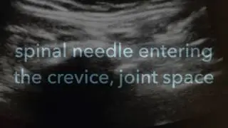 Ultrasound Guided Sacroiliac Joint injection