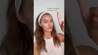 Acne on hairline😳, are you sure that&rsquo;s not what causes it?🙌🏻#acne #acneproneskin #skincare
