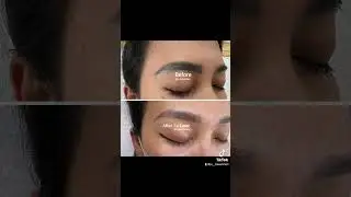 LASER ALIS !! HASIL 1X LASER ! #laser #tiktok #viral #alis #lasertattooremoval #fyp #batamindonesia