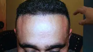 Art of Hair Transplant Restoration | 6.5-Month Manual FUE Results
