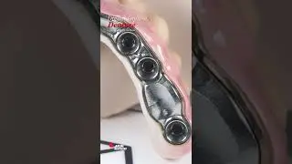 Digital Implant Denture [Designed by DT. Oh Du Hwan]