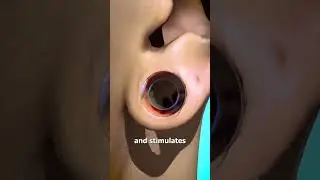 How Ear Gauges Can Tear Your Ears 👂