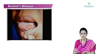 Bechet's Disease (Hindi) : Internal Medicine 🌟🌟🌟