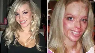 Era JOVEN y BELLA pero un M0NSTRU0 se cruzó en su CAMINO - La Historia de Katie Piper 👁️