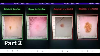 Real-time Skin Cancer (Melanoma) Detection Android App Using TFLite (GPU): Load Model Part 2