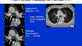 CCTA Training Video 9 Non Cardiac Non Vascular Findings