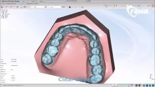 Alineadores invisibles con Maestro3D Dental Studio / Ortho Studio