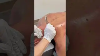 Soothing chiropractic treatment with the calming gua sha scraping #orlando #guasha #florida #asmr