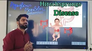 Hirschsprungs disease|lec1|