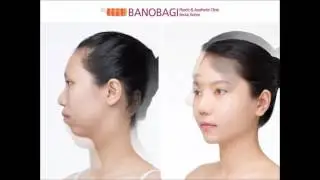BEFORE & AFTER Plastic Surgery at Banobagi PS Clinic, KOREA