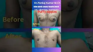 Puffy nipples treatment| Gynecomastia treatment in Ranchi #shorts #youtubeshorts