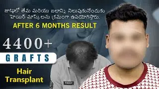 BIO-FUE హెయిర్ ట్రాన్స్&zwnj;ప్లాంట్ ఫలితం | NW-3 బోల్డ్నెస్ | Hairfree & Hairgrow Hyderabad