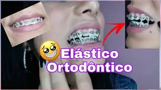 MUDEI A FORMA DOS ELÁSTICOS NO APARELHO ORTODÔNTICO| 22° MANUTENÇÃO| por Pry Mattos