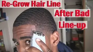 How to ReGrow your Hairline Naturally: After Bad line up/Haircut!