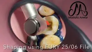 Following the Long Axis of MB Canal in Maxillary First Molar during Mechanical Preparation | RCT