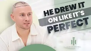 Redefining Look: Charlie's Journey to a New Hairline in Istanbul