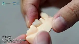 Zirconia all-zirconia crown - single guan