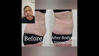 Liposuction + Bodytite