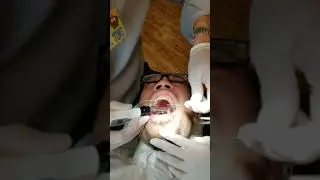 Demonstration on removal of MSE(Maxillary Skeletal Expander) by Dr Ting