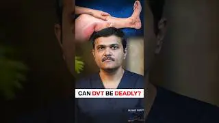 Can leg swelling be FATAL? #bloodclot #shortvideo