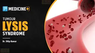 Tumor Lysis Syndrome [General Medicine] - Prepladder NEET SS