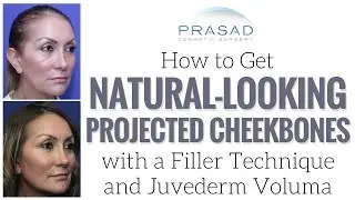 How to Get Projected, Natural-Looking Cheekbones with Deep Placement of Cosmetic Filler
