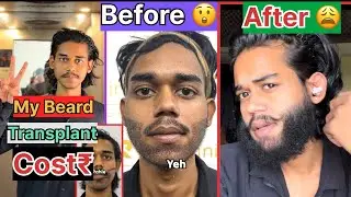 My Beard Transplant Full Details || Hair Transplant In India || Transplant experience Journey