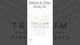 Body Lift: Before & After