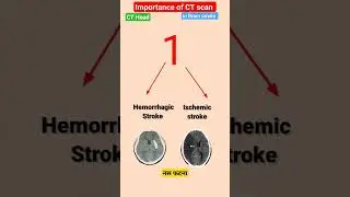 Importance of CT Scan in Brain stroke l CT Head #stroke #shorts