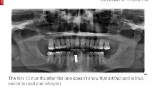 Z5c: Tooth #26 + 1 year post-treatment photos