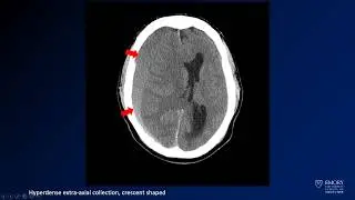 Neuroradiology board review lecture 1 case 8