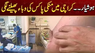 Beware Monkeypox Epidemic Has Started Spreading In Karachi | Breaking News | City21