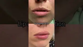 Lip augmentation 👄#cosmetology #lips #lipaugmentation #top #viral #viralshort #viralvideo #shorts