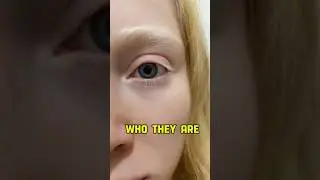 White As Snow Skin? (Insanely Amazing😱) #white #rarecondition #viralshorts