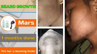 BEARD GROWTH ! 1 months done ✔️ Thin hair is becoming thicker ! How to grow a beard 