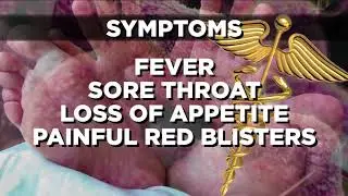 Hand, Foot & Mouth Disease symptoms; 'Miserable virus' spreads in MI