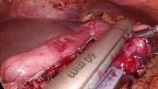 BMI 55, Sleeve gastrectomy