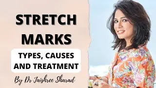 Stretch Marks | Types, Causes and Treatment for stretch marks | By Dr Jaishree Sharad