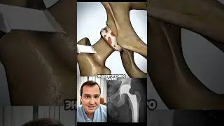 Эндопротезирование тазобедренного сустава #drtyshch #дружелюбныйортопед #tyshch_rec #tyshch