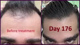6 MONTHS RESULTS OF USING FINASTERIDE, DUTASTERIDE AND MINOXODIL  #hairgrowth #hairloss #hair