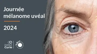 Comprendre le traitement oculaire des mélanomes uvéaux