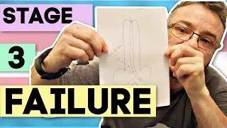Failed Attempt At Stage 3 Erectile Device (Phalloplasty)