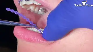 Braces Check up - Changing Power Chains - Tooth Time New Braunfels