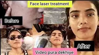 Face laser treatment/// before /After// video pura dekhiye!!!!!!💯💯💯🙏🏻🙏🏻👍🏻👍🏻👍🏻💞👈🏻