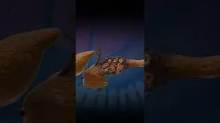 3D Animation of Pancreas Damage [Medical Animation]