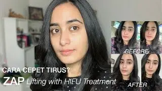 ZAP Face Lifting Review & Results ♡ | Indonesia | Prisya Thalia Basir