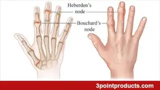3PP Oval-8 Finger Splint